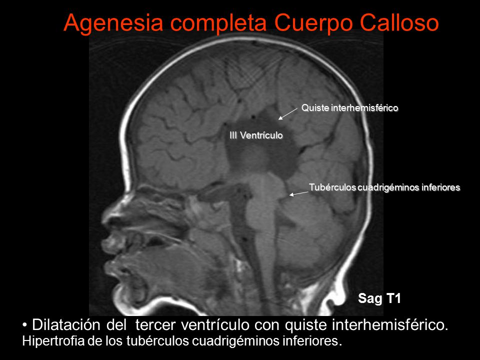 hipoplasia agenesia del cuerpo calloso